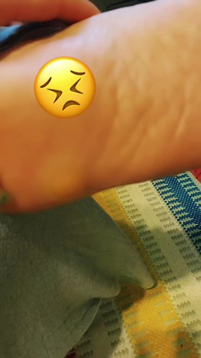 How to Remove Glass from Your Foot Painlessly