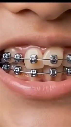 tooth bracing procedure