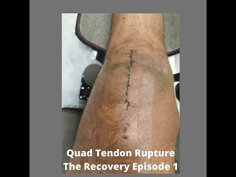 Quad tendon rupture The Recovery: Episode 1