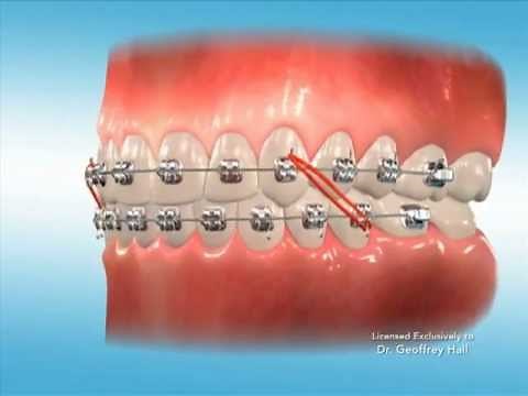 Advanced Orthodontics - Elastics