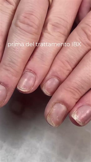 IBX - Prima e dopo 1 solo trattamento