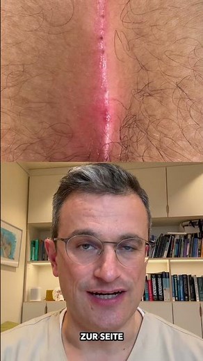 Effektive Behandlung von Steißbeinfisteln: Moderne Methoden in unserer Praxis