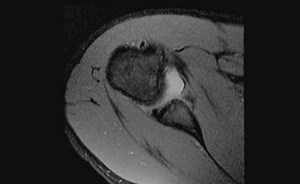 H&P (History and Physical Exam) to MRI: Clinical Correlations of the Shoulder