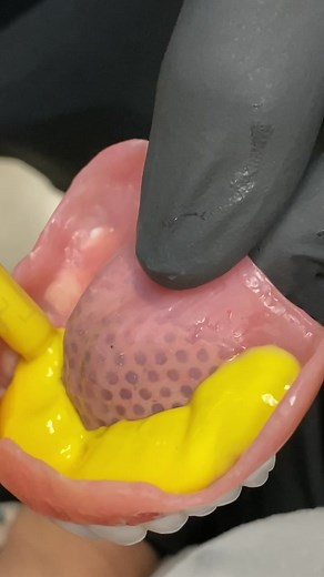 Denture Relining Process - Step by Step Guide