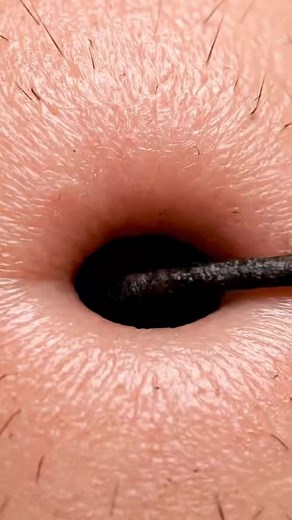 5.7K views · 15 reactions | Detailed Pore Extraction and Acne Treatment ASMR 5PTW #Skincare #BlackheadRemoval #PoreCleaning #AcneCare #SatisfyingVideo Enjoy calm, clean, and deeply satisfying skin-care moments with gentle pore cleaning and a relaxing visual experience designed to refresh and soothe. Disclaimer: This video is created for educational and relaxation purposes using AI-generated demonstrations. | Ashik 0.2 | Facebook