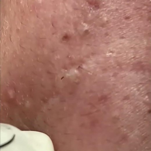 Intensiv & befriedigend: Blackheads und Akne entfernen | Pickel ausdrücken Shorts