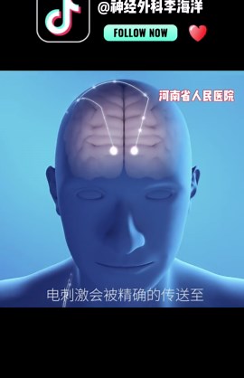 一起来看看做为目前脑机接口临床应用范例的脑起搏器是怎么工作的吧#脑起搏器 #DBS #帕金森 #震颤 #脑机接口