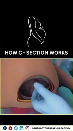 Cesarean Section Explained: Why Doctors Choose C-Sections for a Safer Birth 👶✂️ #Cesarean #Birth