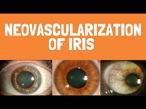 Causes of Neovascularization of iris | Rubeosis iridis | Ocular signs