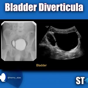 3.6K views · 125 reactions | Bladder Diverticulum . . . . . . . #ultrasound #radiology #imaging #ultrasonido #medical #medicine #ultras #ultrasonography #mri #xray #doppler #health #radiologist #healthcare #ultrason #loveultrasound #nursing #sonography #vascular | John Z Wetmore | Facebook