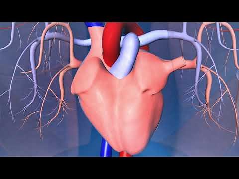 Implantable Cardioverter-Defibrillator (ICD)