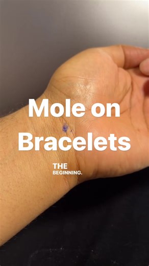 Understanding Palmistry: The Meaning of Moles