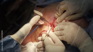Close-up plastic surgical operation to lift the neck and remove the second chin. The doctor separates the patient's skin with surgical forceps and cuts off with scissors
