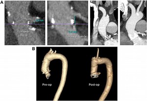 Aortic Root Replacement of Small Roots to Prepare for Transcatheter Aortic Valve Replacement