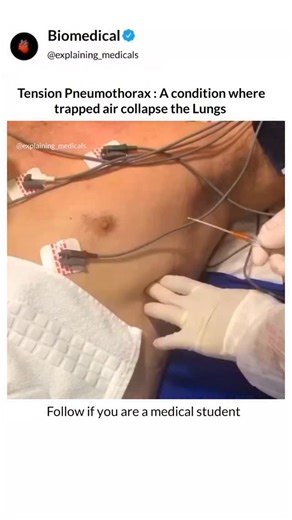 BIOMEDICAL on Instagram: "Follow @explaining_medicals ⬇️⬇️⬇️⬇️ What text books can't show you, We animate. Tension pneumothorax is a life-threatening emergency where trapped air collapses the lung and shifts the heart. The key lifesaving step is needle decompression—a large-bore needle in the 2nd intercostal space, midclavicular line, releases trapped air. Follow with a chest tube to fully re-expand the lung and stabilize breathing. . . . . . 📝 | Hard Concepts, Simplified in 30 Seconds 📚 | Tir