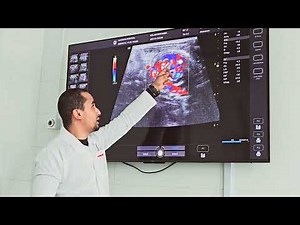 Diagnosing midgut volvulus with intestinal malrotation in neonate
