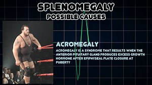 Splenomegaly (Medical Symptom)