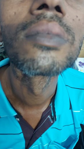 2.2M views · 4.7K reactions | Tongue cancer #reelsvideoシ #Cancer #fashion #reelsfypシ #health #Salam #tumor #টিউমার #cancersurvivor #cancerawareness 01715090807 | Cancer Care by Dr.Salam | Facebook