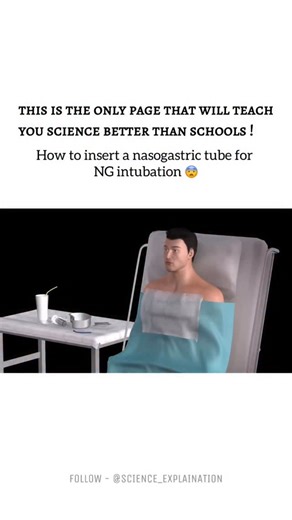 Science on Instagram: "Nasogastric intubation is a medical procedure in which a soft, flexible tube is passed through the nose, down the throat, and into the stomach. It is commonly used for feeding, administering medicines, removing stomach contents, or relieving gastric pressure. The procedure is performed by trained healthcare professionals under proper medical supervision. Correct placement is essential and is usually confirmed by clinical methods or imaging to avoid complications such as mi