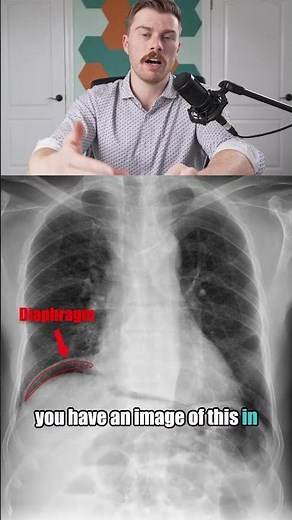 Pneumoperitoneum on X-Ray: Don’t Miss This