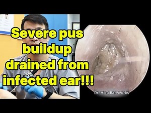 Severe pus buildup drained from infected ear | ear cleaning | ASMR earwax | soothing |relax|