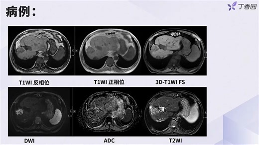 1.3 结合病例解读常见病理改变的 MRI 信号特点