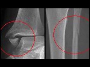 Fratura Tornozelo e Fíbula de Maisonneuve (pós operatório) Clínica de Fisioterapia Dr. Robson Sitta