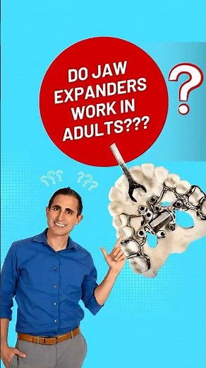 Do Jaw Expanders Work in Adults? | #palateexpansion