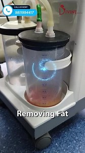 Gynecomastia Grade 2A 360° Surgery | Before and After Male Chest Reduction