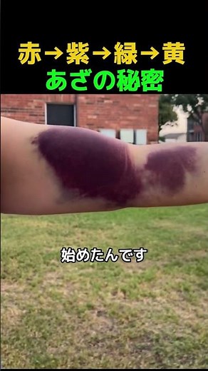 Why bruises change color