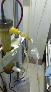 plasma draining #plasma #plasmapheresis