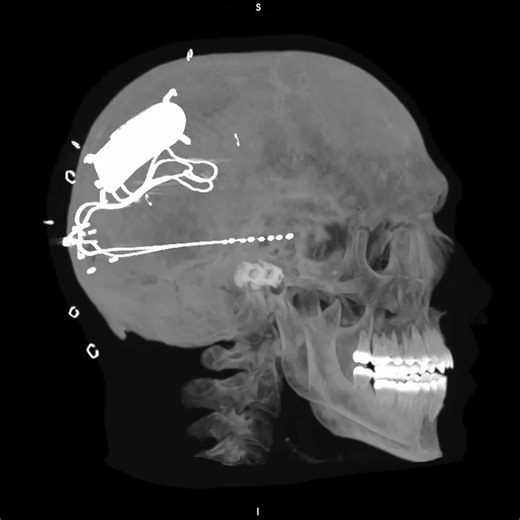 3.8K views · 47 reactions | Discover the benefits of the RNS System in managing #epilepsy. 易This innovative seizure device detects and responds to seizures at their source. Wondering if you qualify? Take our quick quiz to find out! ➡️https://neuropace.com/patients/rns-system-quiz/ Video Credit: IG @mian.neurosurgery RNS System safety info: www.neuropace.com/safety | NeuroPace RNS System for Epilepsy | Facebook