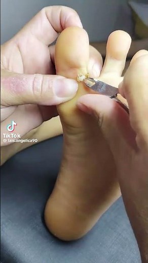 O maior bicho de pé que eu ja vi - “So Satisfying! Removing a Chigoe Flea at Home 😳”