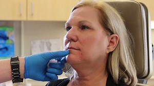 Juvederm and Restylane Silk: The Doctor Explains How to Use Them