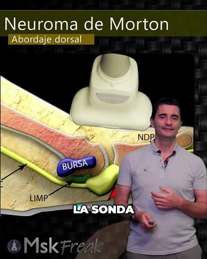 Morton's neuroma on ultrasound: diagnostic keys