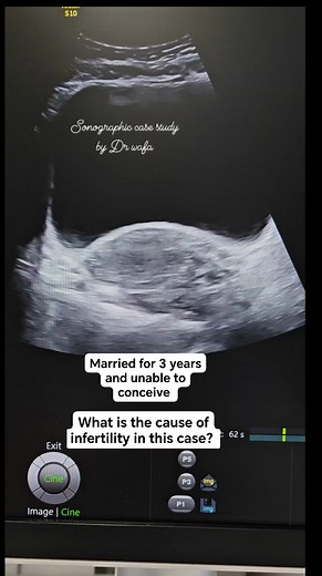 64K views · 362 reactions | DIAGNOSIS? INFERTILITY ULTRASOUND RADIOLOGY SONOGRAPHY #sonographiccasestudy #fblifestyle #education #reelsvideo | Sonographic case study | Facebook