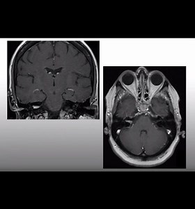 Translabyrinthine Resection of Small Intracanalicular Acoustic Tumor