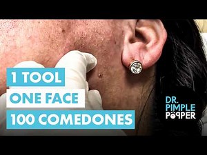 1 Extractor vs 100 Jaw Comedones