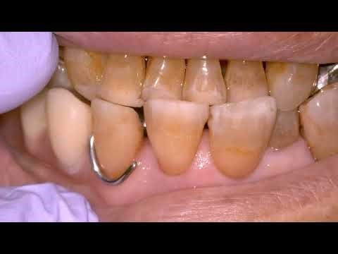 Er：YAG laserーassisted subgingival debridement