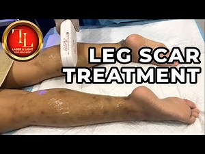 Leg Scar Removal Treatment [Laser Light Skin Centre]