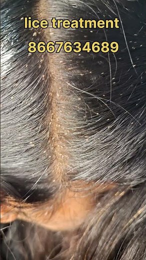 How to remove nits and lice treatment #nits #hair #liceremoval #coimbatore #haircare #licetreatment