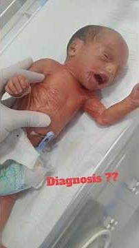 Newborn with Collodion Membrane | Rare Skin Disorder in Neonates