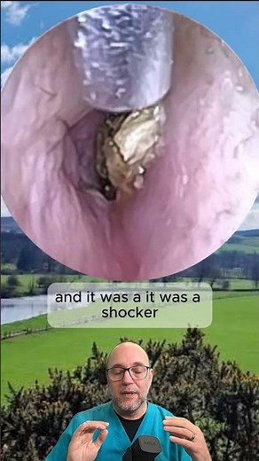 Unexpected CAVITY! Full video in link below