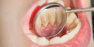 Worried About Plaque Buildup? Use These Ingredients From your Kitchen To Combat It | Herzindagi