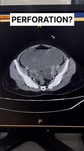 Perforation Peritonitis CT | Pneumoperitoneum #shorts