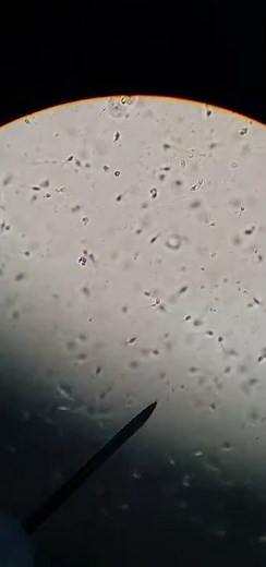 Progressive Motility(also called Forward Progression) in Sperm.This is one aspect of Semen Analysis.