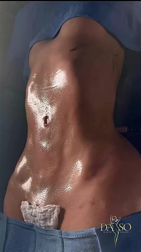 Transformaciones con resultados maravillosos, échale un vistazo a este BBL. 🗓️ Agenda tu cita hoy y transforma tu figura. 📞 Llámanos al 305-575-2375 📍 Visítanos en 7902 NW 36th St, Suite 202, Miami, FL Descubre cómo nuestro equipo de expertos puede ayudarte a lograr el cuerpo que siempre has deseado.😍✨