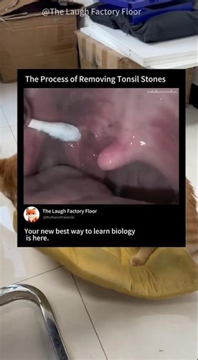 🪨This is how tonsil stones are removed 🥢 | MDCT