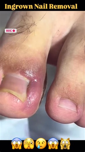 210K views · 1.9K reactions | From swollen toe  to pain-free again!  Watch the magic happen  #ingrownnail #toenailremoval #swollentoe #footrecovery #satisfyingreel #nailrestoration #toecare | Podiatrist-SJ | Facebook