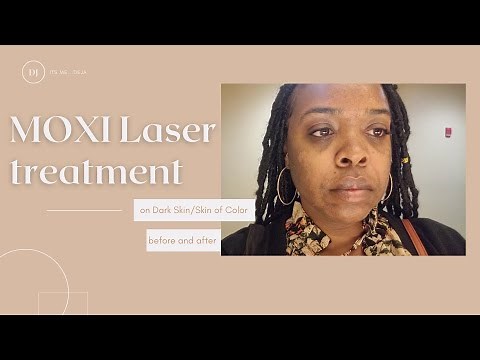 MOXI Laser treatment for hyperpigmentation on dark skin